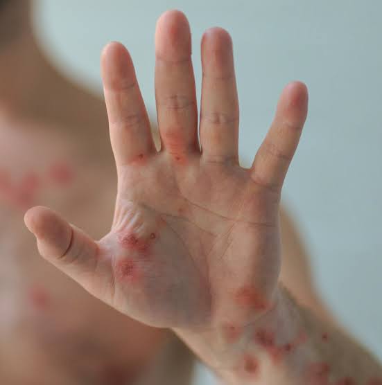 Philippines Reports First Mpox Case in Calabarzon Region