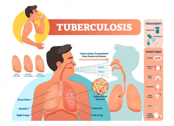 Oriental Mindoro Exceeds Targets in Tuberculosis Screening Drive